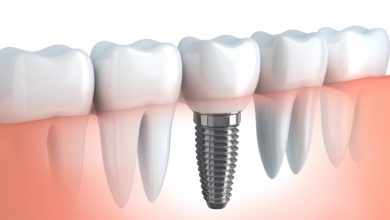 Dental Implant Treatment in Brampton
